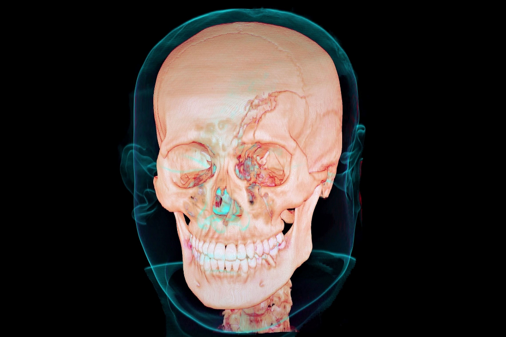 CRANIOPLASTY